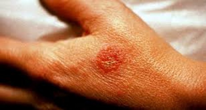 Covid-19 pandemisi egzamayı artırdı